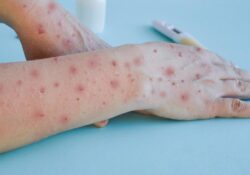 Estados Unidos declara alerta máxima por viruela; suman 6,600 casos