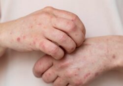 OPS emite alerta epidemiológica por sarampión; México más de 6 mil casos