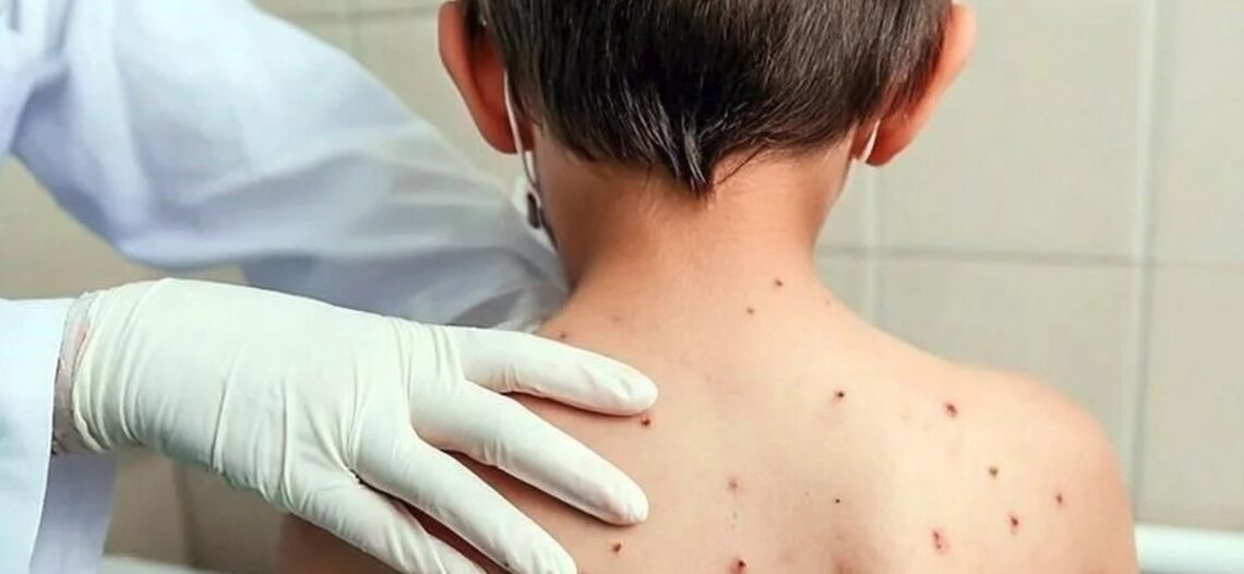 México registra 133 casos de sarampión en las primeras semanas de clases