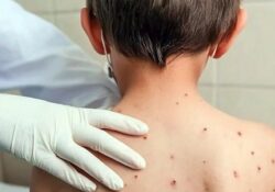 México registra 133 casos de sarampión en las primeras semanas de clases
